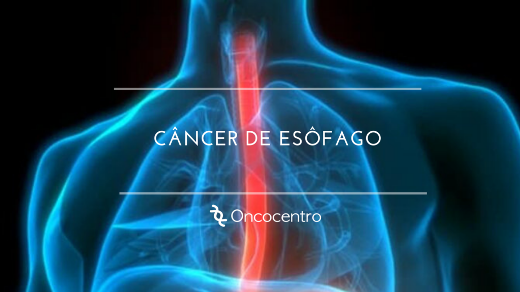 Câncer de Esôfago Oncocentro